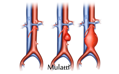 Aneurisma da Aorta – Devo me Preocupar?